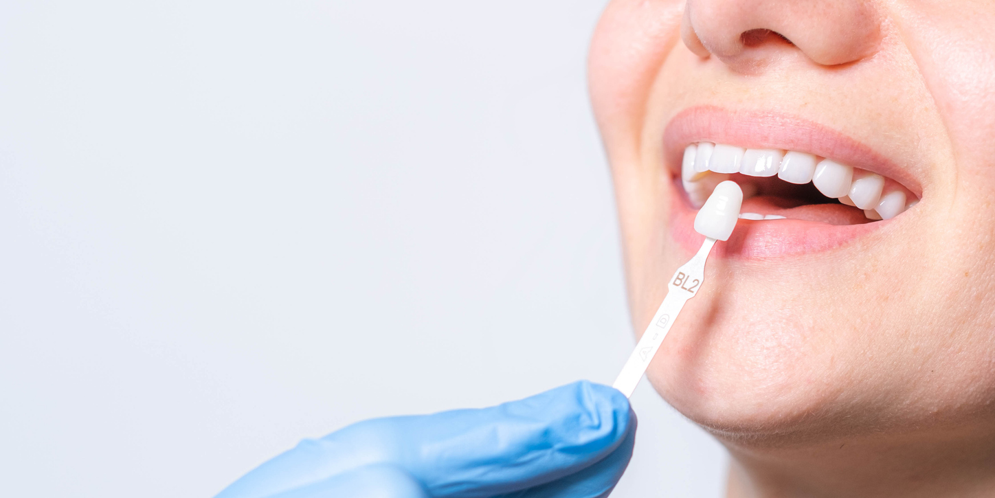 Tooth whitening and perfect white smile -Trillium Dental 