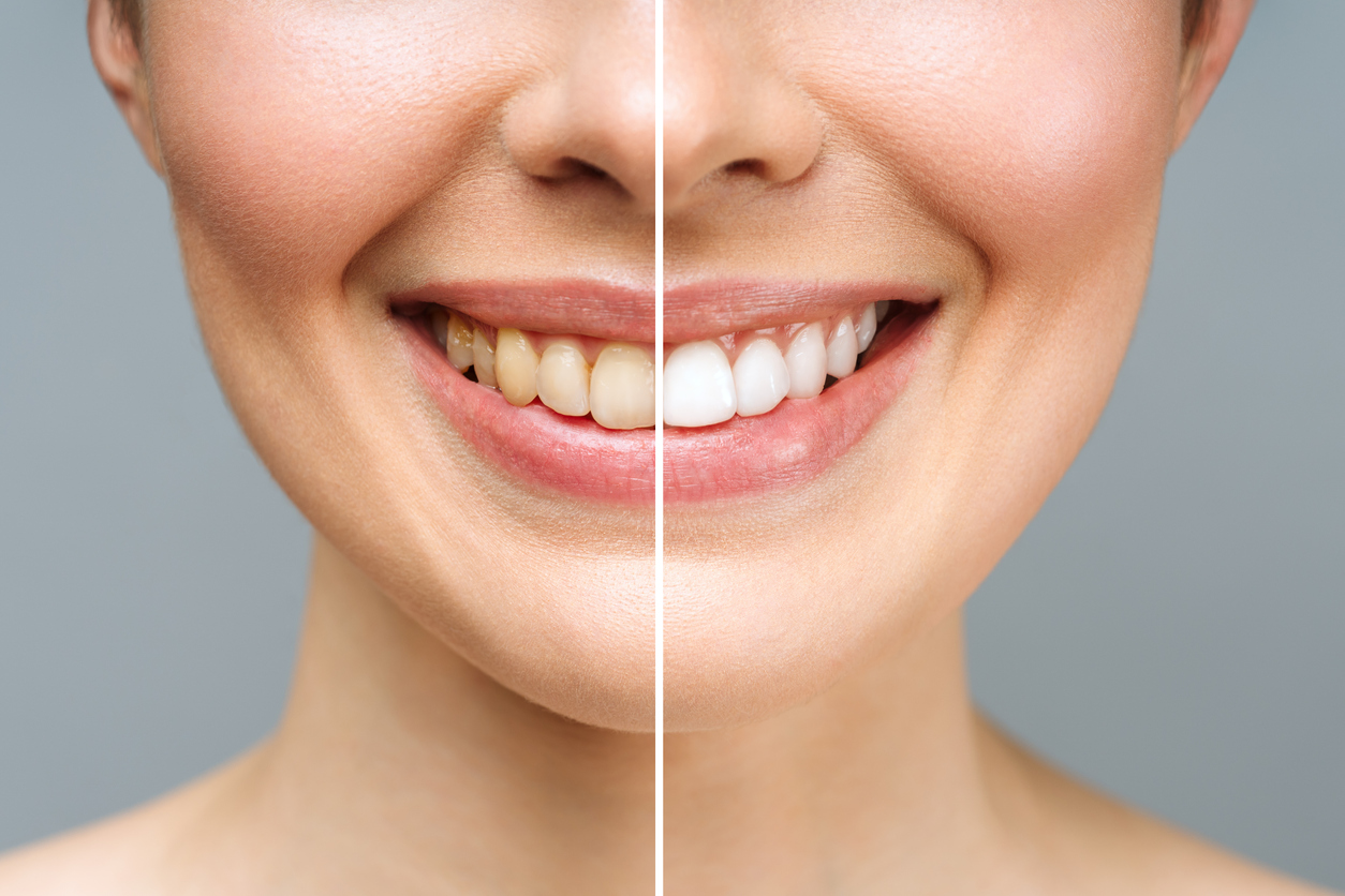 woman teeth before and after whitening.